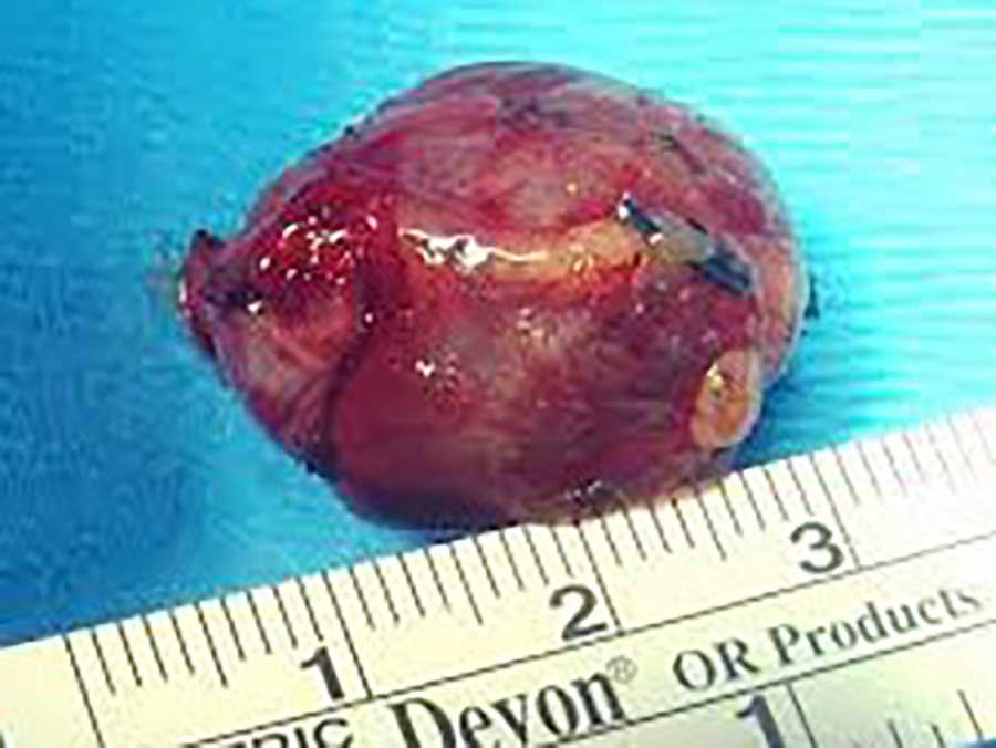 Adenoma Paratiroideo