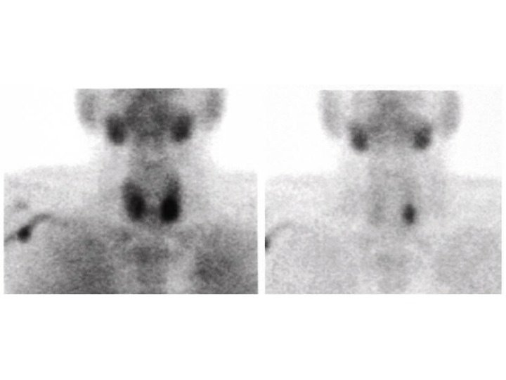 Sestamibi Mostrando un Adenoma Paratiroideo Izquierdo